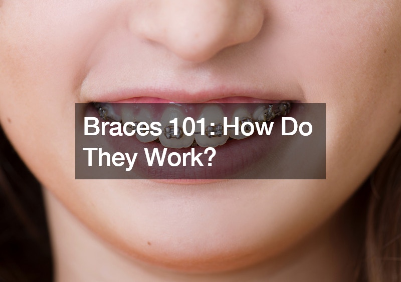 Braces 101 How Do They Work?